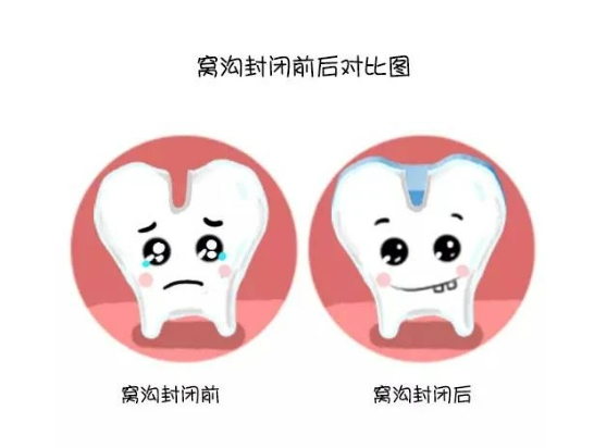 窝沟封闭适用于哪些儿童?有哪些优缺点？