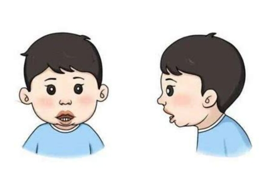 凸嘴矫正的多种方案：哪种最适合你?