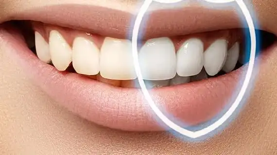 种牙牙冠和邻牙颜色不一样:可以调整吗? 种牙牙冠和邻牙颜色不一样:可以调整吗?