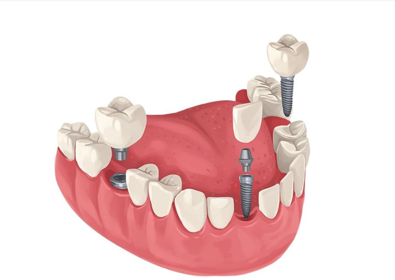 活动假牙和种植牙：如何根据自身条件做出明智选择？