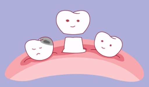 种植牙打完“地基”,千万别乱吃!