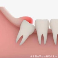 智齿有哪些危害？拔智齿前需要做哪些准备？