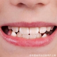 宝宝换牙后长出锯齿正常吗？