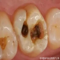 蛀牙不补的危害，如何预防和治疗蛀牙？