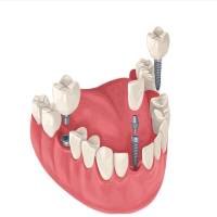 种牙后伤口裂开是否需要二次缝合？